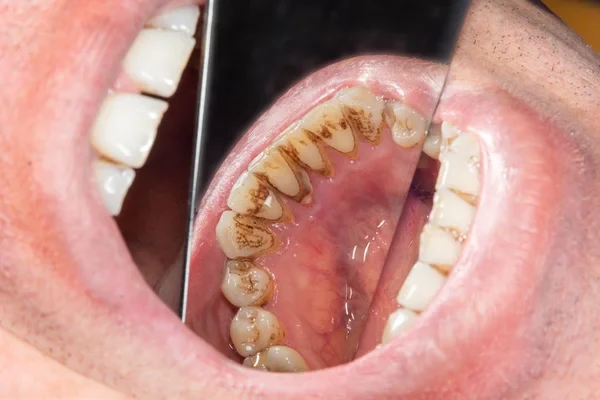 dientes humanos con sarro dental