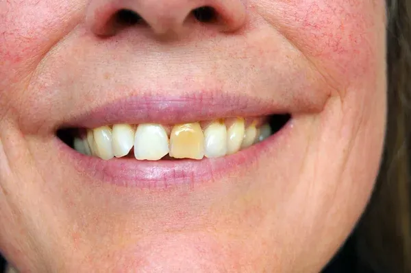 mujer con manchas en los dientes
