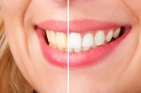 tratamiento de blanqueamiento dental para manchas blancas en los dientes