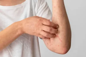 ¿Cómo saber si tengo alergias por estrés?